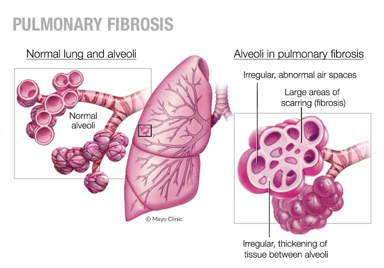 Medical illustration showing a healthy lung and one with pulmonary fibrosis